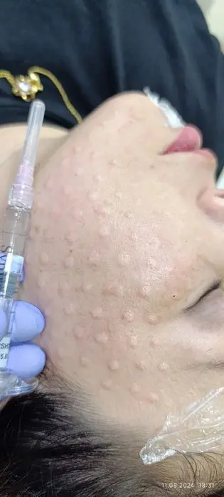 Mutlaqo bezarar muolaja biorevitalizatsiya .
