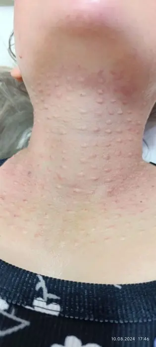 Mutlaqo bezarar muolaja biorevitalizatsiya .