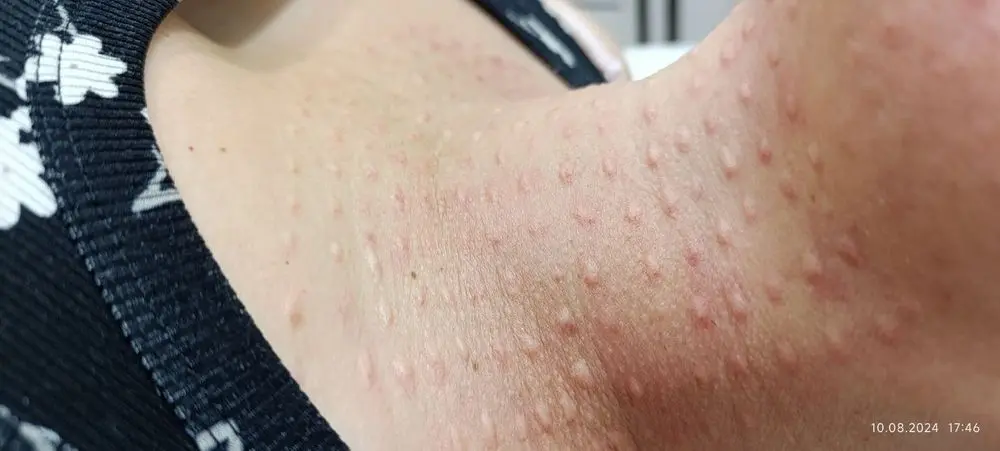 Mutlaqo bezarar muolaja biorevitalizatsiya .