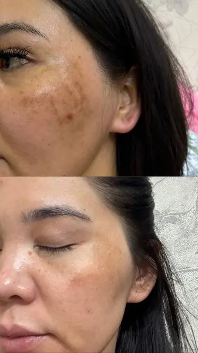 Mutlaqo bezarar muolaja biorevitalizatsiya .