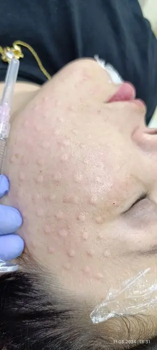 Mutlaqo bezarar muolaja biorevitalizatsiya .